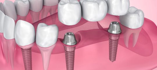 implant dentaire basal