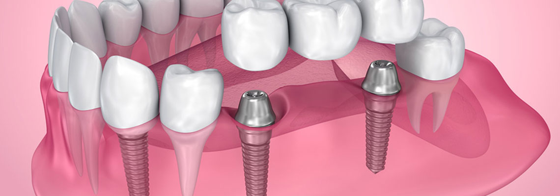 implant dentaire basal